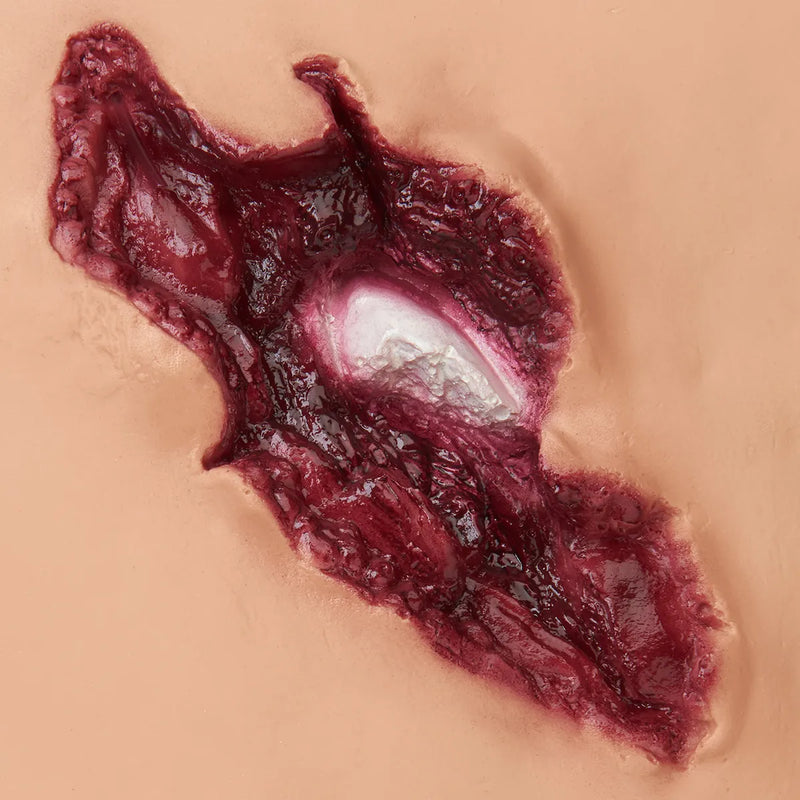 Carregar imagem no visualizador da Galeria, Fratura Composta do Fêmur