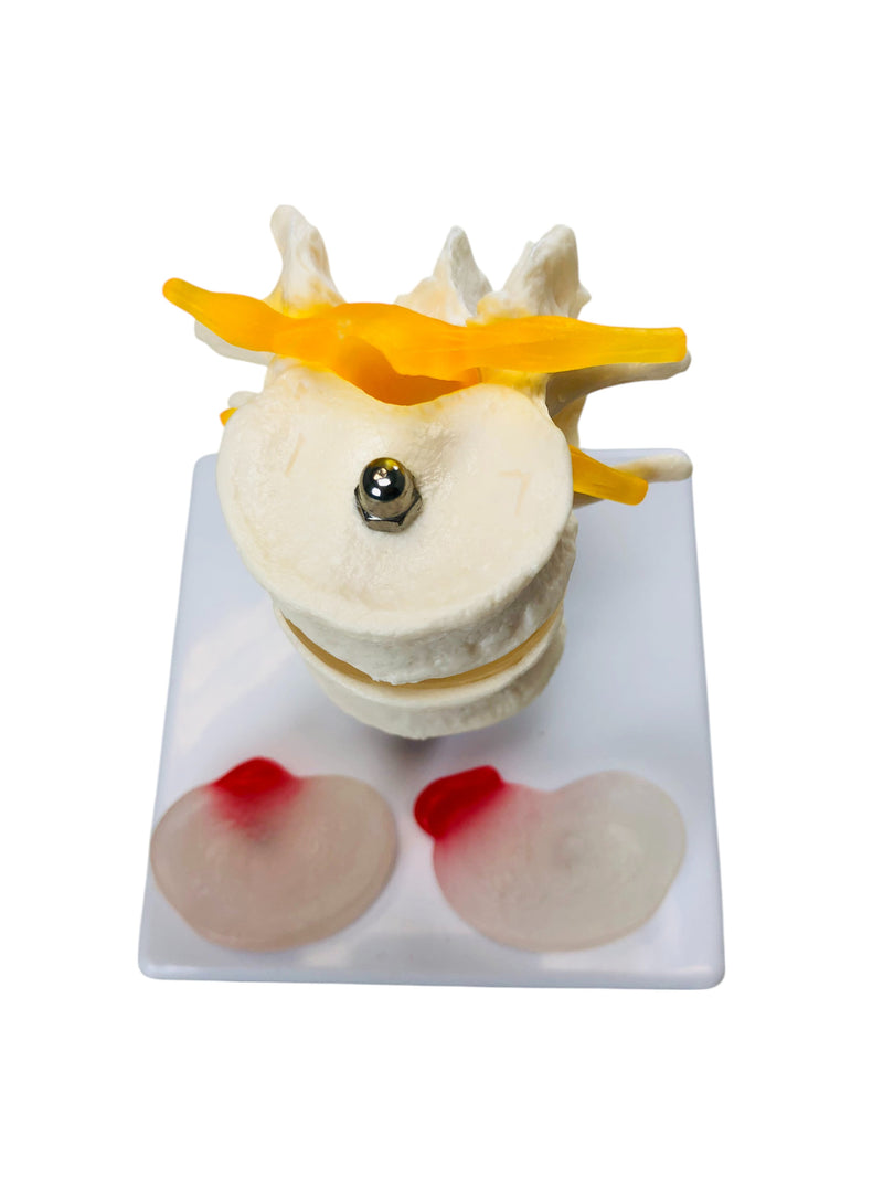 Load image into Gallery viewer, Two Lumbar Vertebrae with Herniation and Prolapse Model