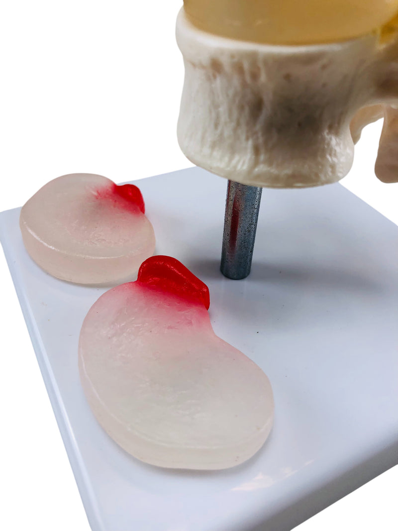 Load image into Gallery viewer, Two Lumbar Vertebrae with Herniation and Prolapse Model