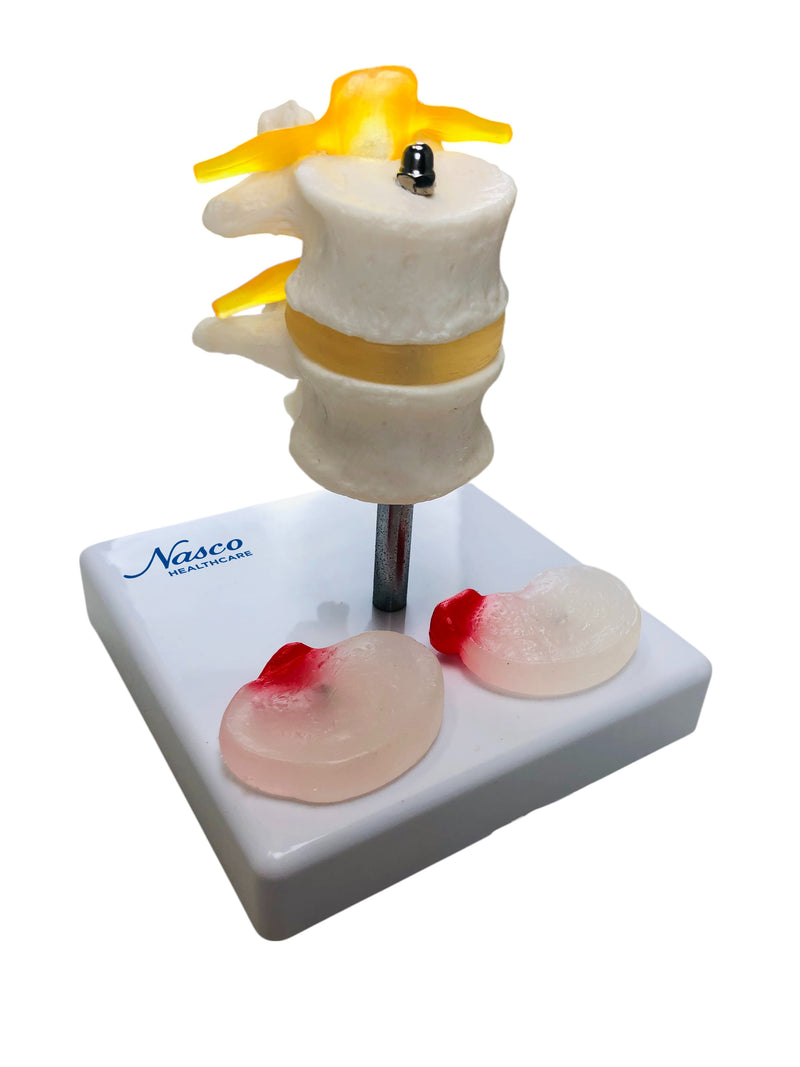 Load image into Gallery viewer, Two Lumbar Vertebrae with Herniation and Prolapse Model