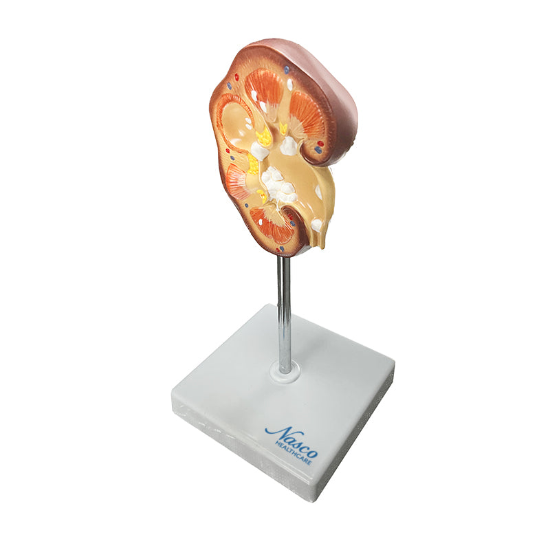 Kidney Stone (Nephrolites) Model [SKU: MG21415] – Nasco Healthcare
