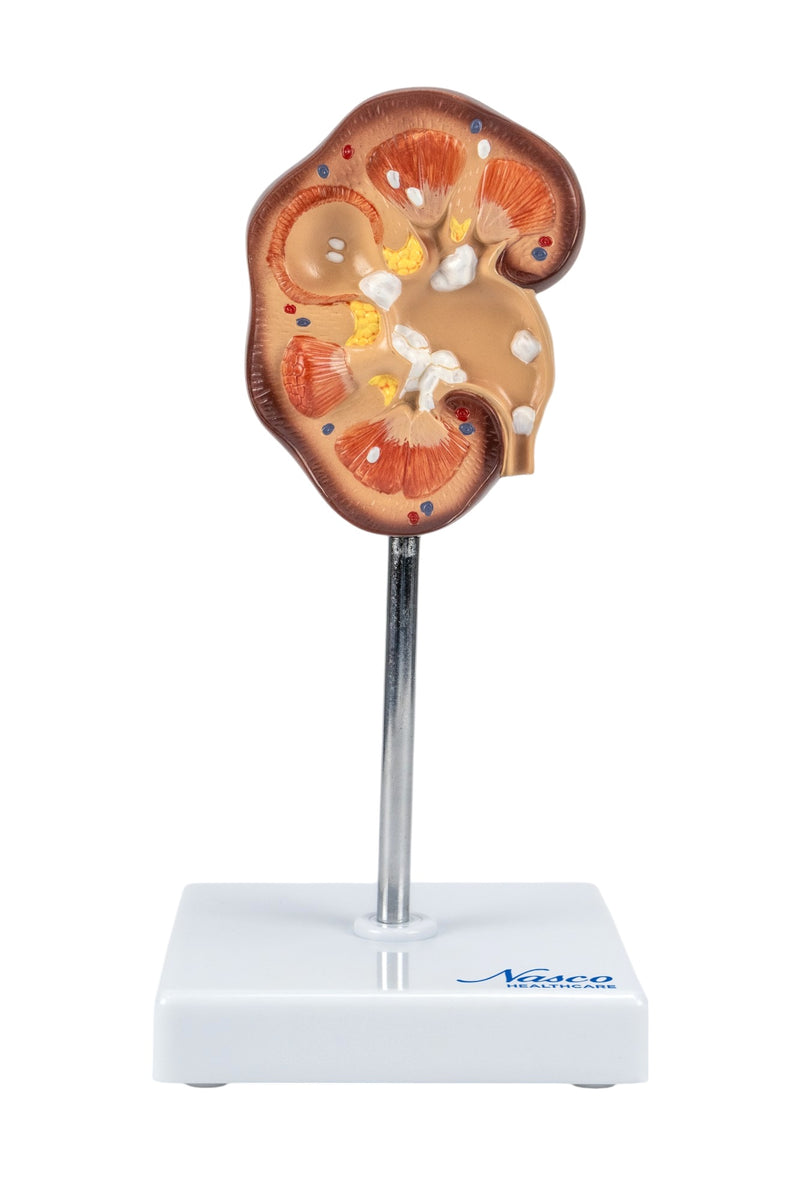 Load image into Gallery viewer, Kidney Stone (Nephrolites) Model
