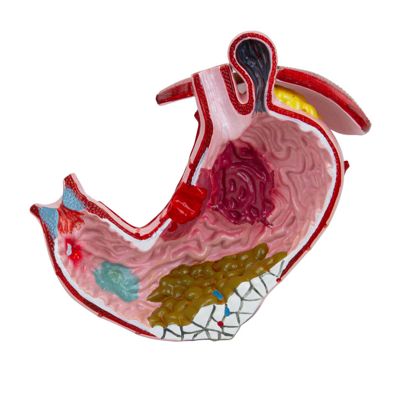 Load image into Gallery viewer, Stomach with Gastric Ulcers Model