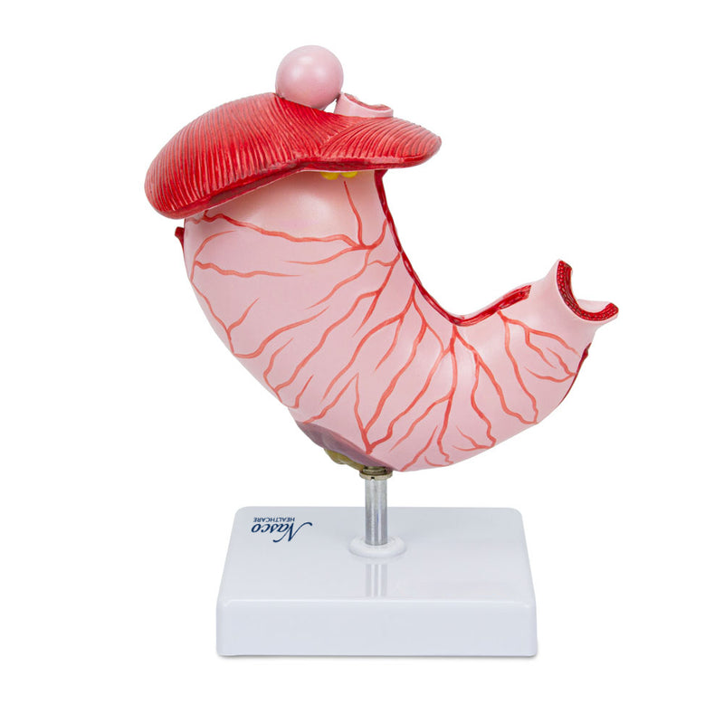 Load image into Gallery viewer, Stomach with Gastric Ulcers Model