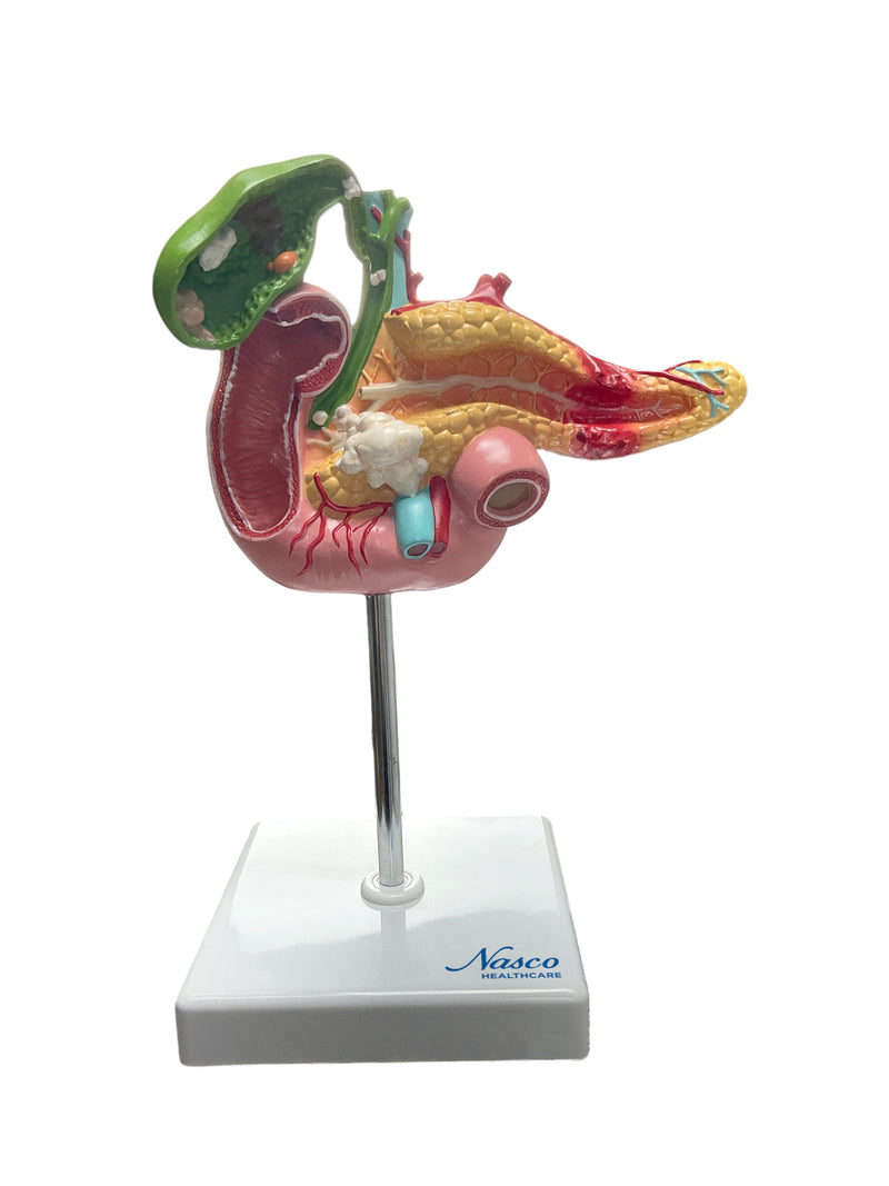 Load image into Gallery viewer, Pancreas, Duodenum, & Gallbladder with Pathology Model
