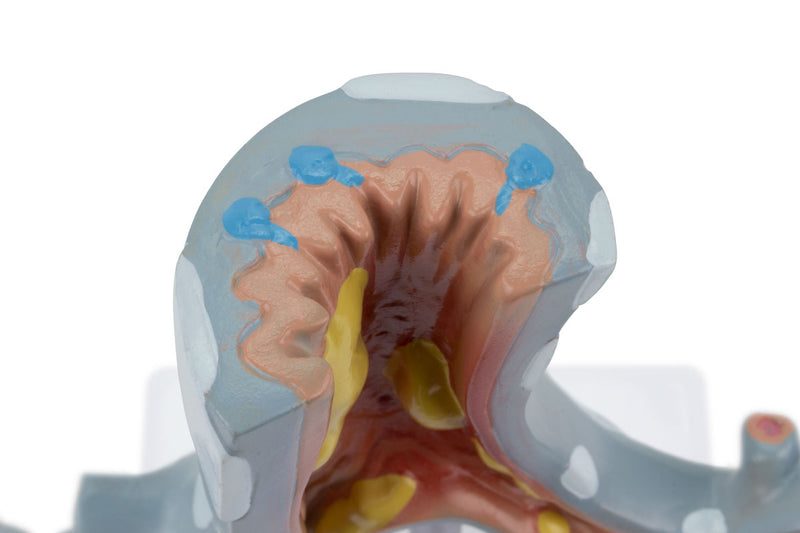 Load image into Gallery viewer, Bronchial Tree Section with Pathology Model, 10X Enlarged