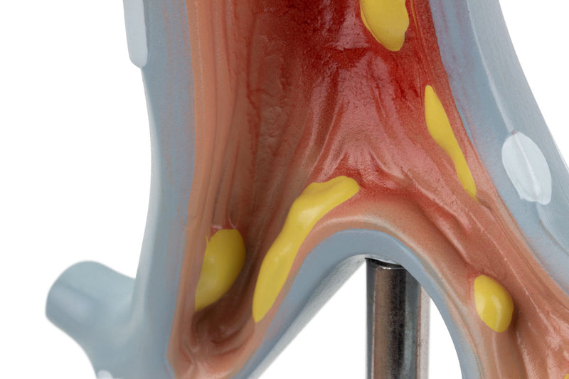 Load image into Gallery viewer, Bronchial Tree Section with Pathology Model, 10X Enlarged