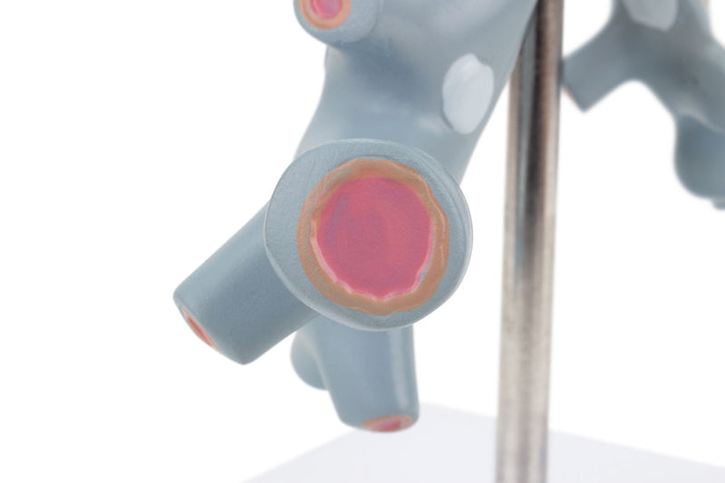 Load image into Gallery viewer, Bronchial Tree Section with Pathology Model, 10X Enlarged