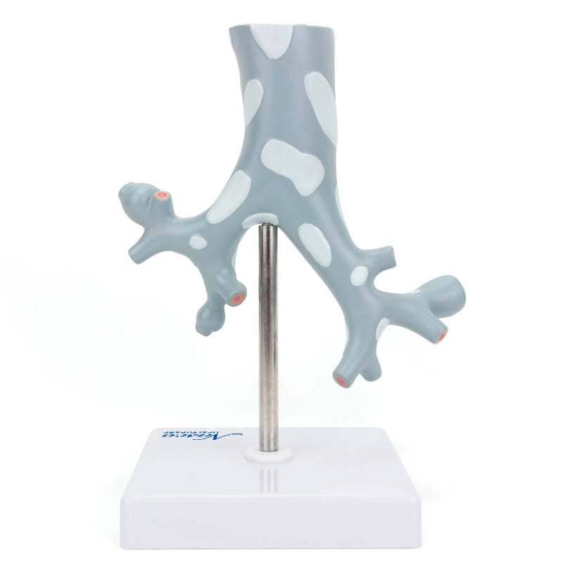 Load image into Gallery viewer, Bronchial Tree Section with Pathology Model, 10X Enlarged