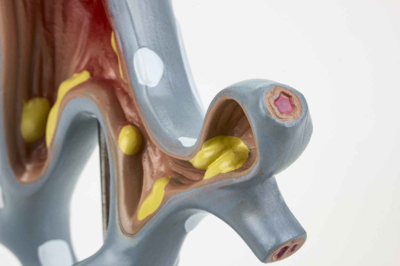 Load image into Gallery viewer, Bronchial Tree Section with Pathology Model, 10X Enlarged
