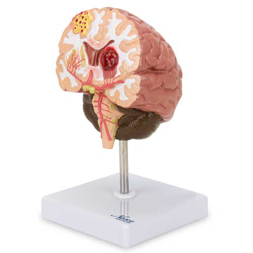 Load image into Gallery viewer, Brain Section with Pathology Model