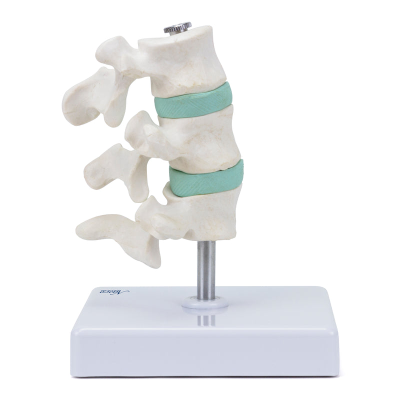 Load image into Gallery viewer, Deluxe Osteoporosis Model, 3 Parts