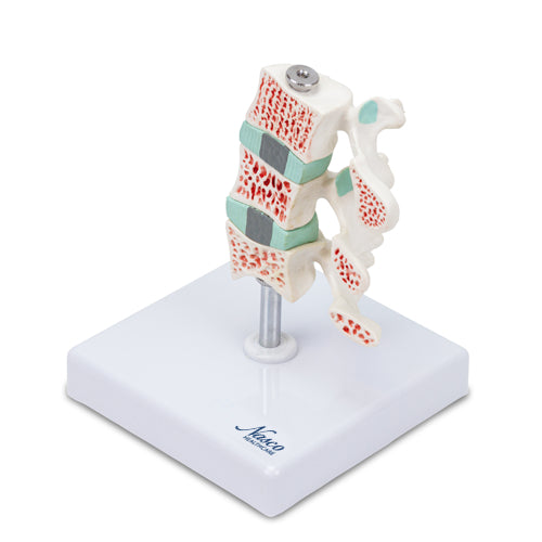 Load image into Gallery viewer, Deluxe Osteoporosis Model, 3 Parts
