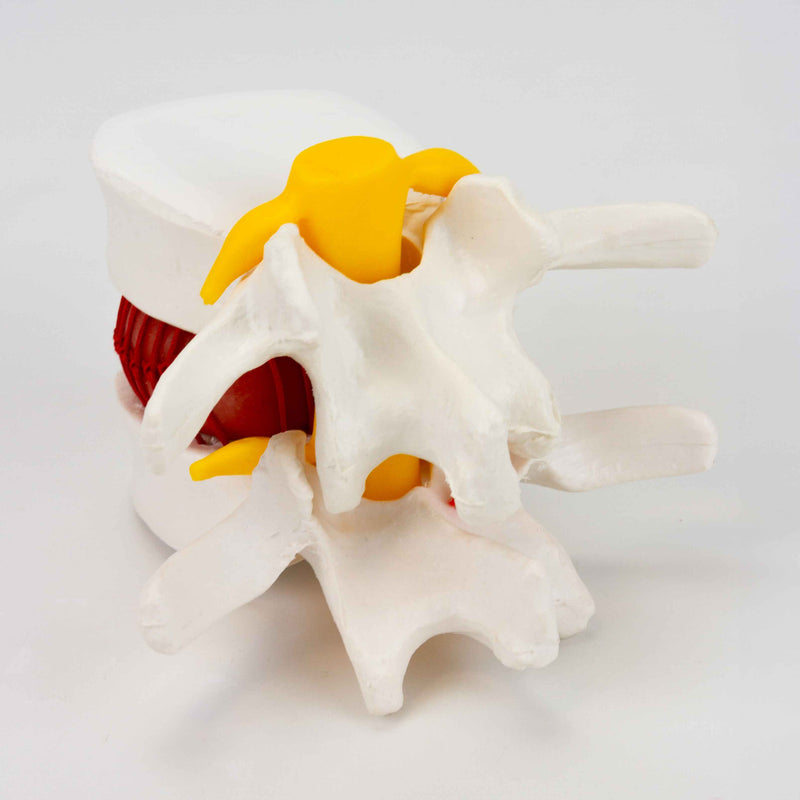 Load image into Gallery viewer, Herniated Disc Demonstration Model