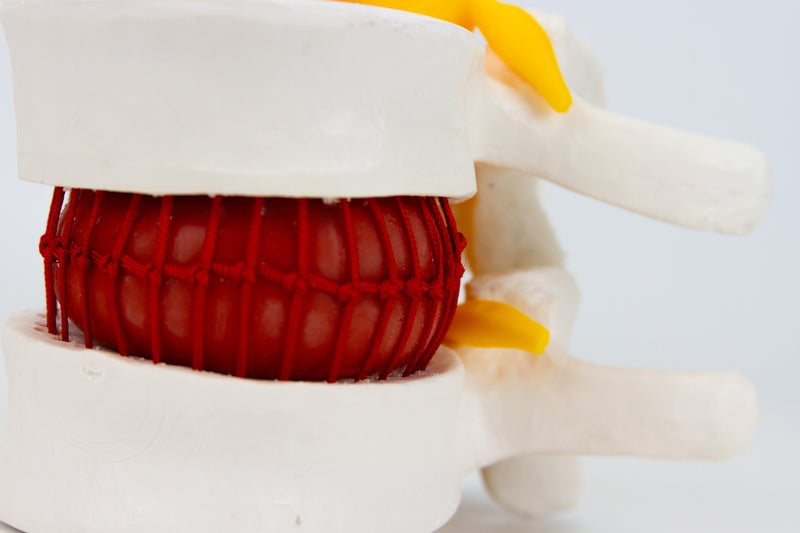 Load image into Gallery viewer, Herniated Disc Demonstration Model