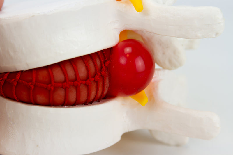 Load image into Gallery viewer, Herniated Disc Demonstration Model