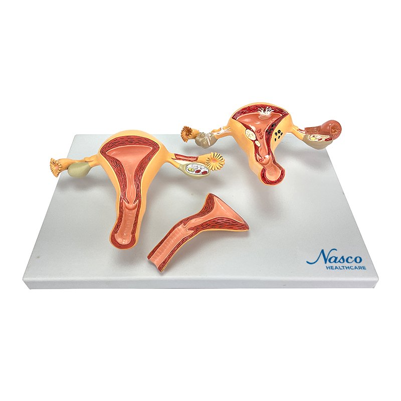Load image into Gallery viewer, Healthy & Pathological Uterus Model