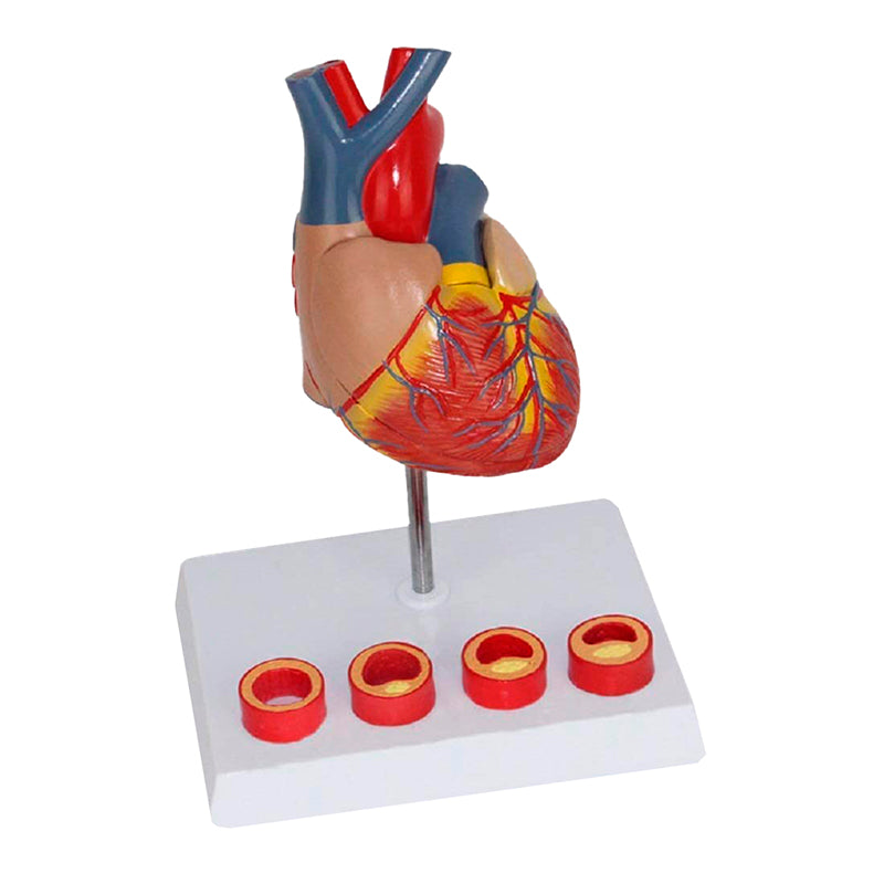 Load image into Gallery viewer, Heart with Arteriosclerosis Model