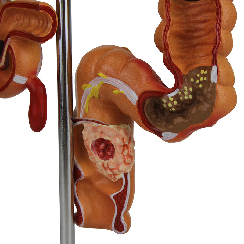 Load image into Gallery viewer, Intestinal Pathologies of Colon & Rectum Model