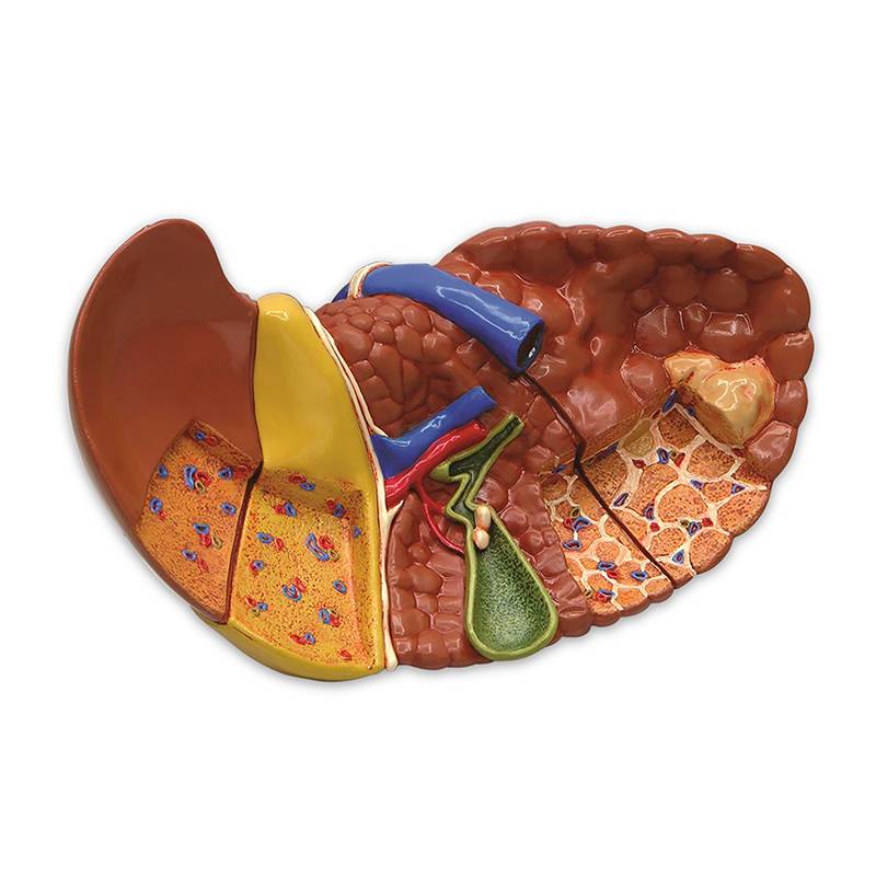 Load image into Gallery viewer, Liver Section with Pathologies Model