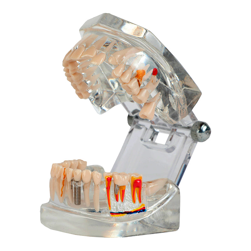 Load image into Gallery viewer, Translucent Adult Dentition Normal and Pathology Model