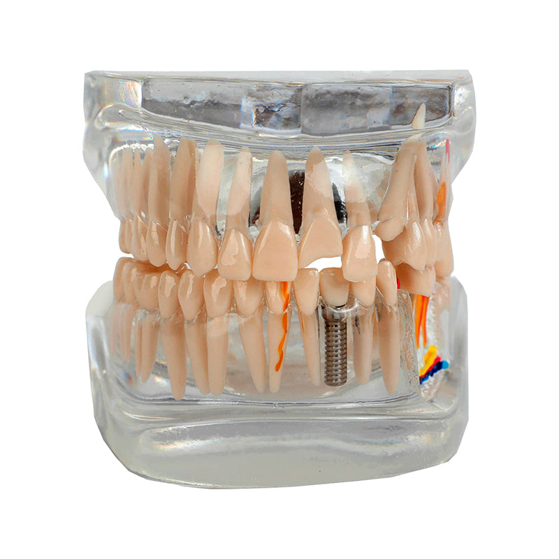 Load image into Gallery viewer, Translucent Adult Dentition Normal and Pathology Model