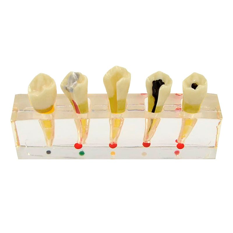 Load image into Gallery viewer, Endodontics Dental Model, 5 Parts
