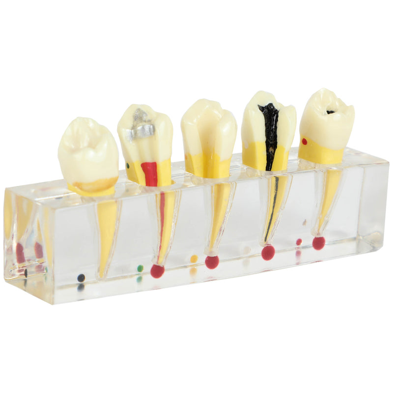 Load image into Gallery viewer, Endodontics Dental Model, 5 Parts