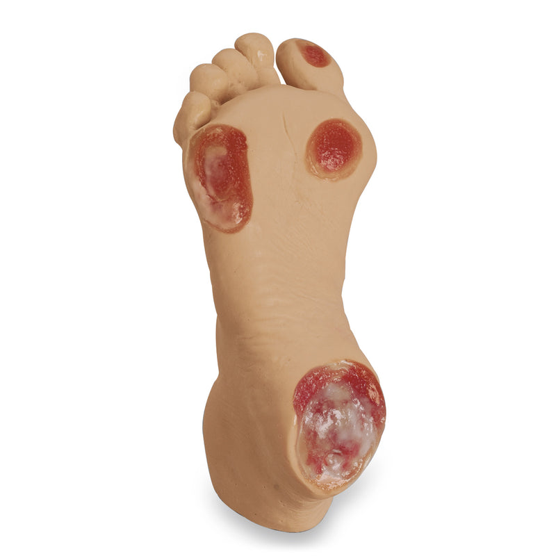 Load image into Gallery viewer, Elderly Pressure Ulcer Foot