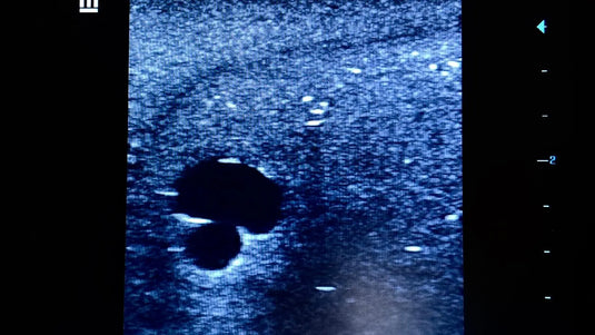 Ultrasound Simulator with 2 Branched Veins