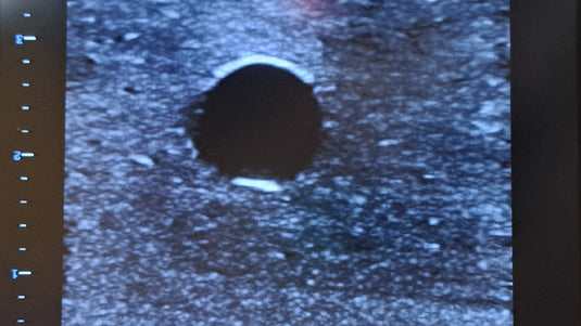 Ultrasound Simulator with 2 Femoral Access Routes