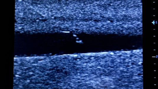 Ultrasound Simulator for Seldinger Technique