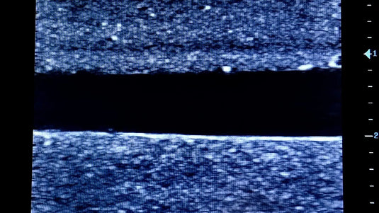 Ultrasound Simulator with 2 Central Lines