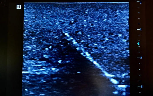 Ultrasound Simulator with Foreign Bodies