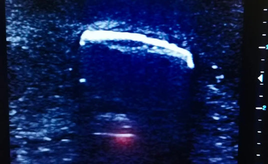 Ultrasound Simulator with Foreign Bodies