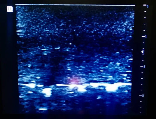 Ultrasound Simulator with Foreign Bodies