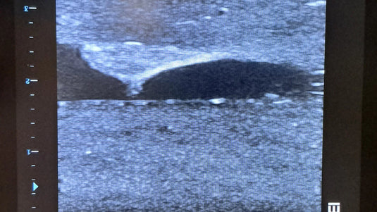 Central Access Ultrasound Simulator with Calcifications