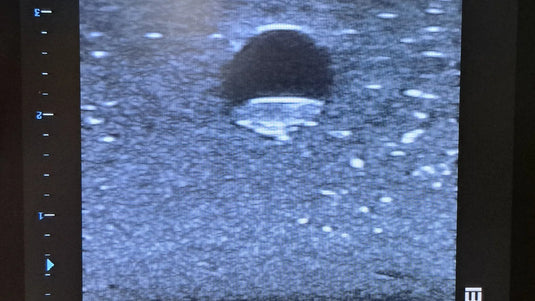 Femoral Access Ultrasound Simulator with Calcifications
