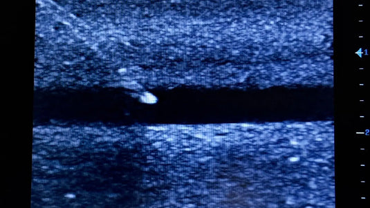 Ultrasound Simulator for Radial Artery Catheterisation