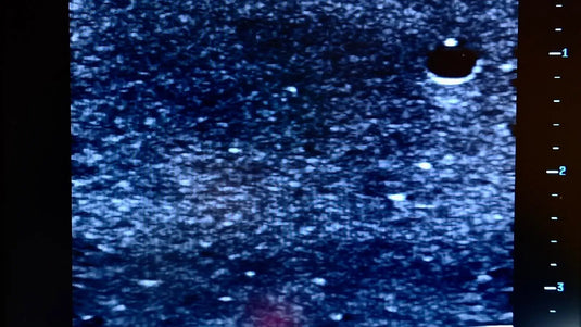 Ultrasound Simulator for Radial Artery Catheterisation