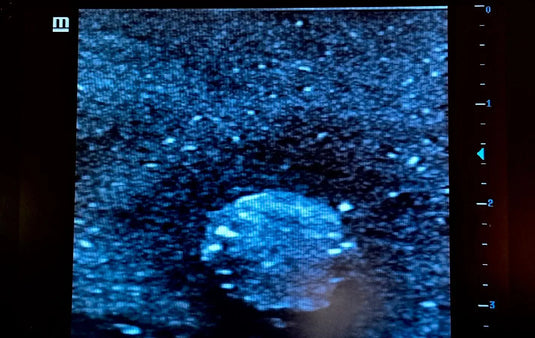 Ultrasound Simulator with Breast Pathologies/Biopsy