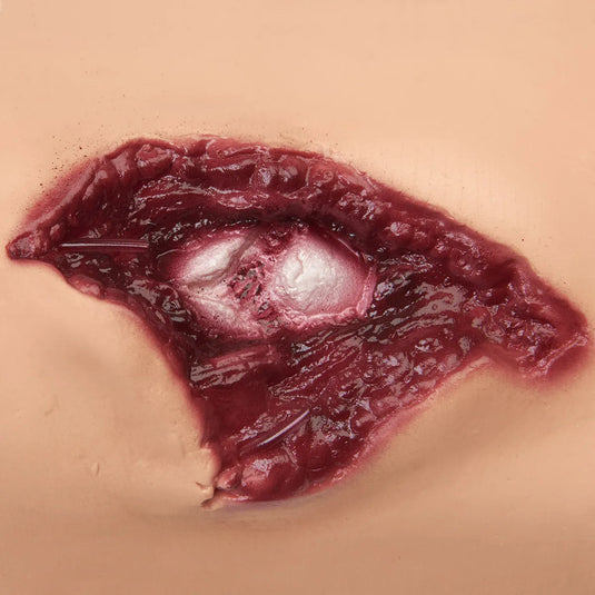 Złamanie otwarte kości ramiennej