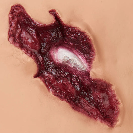 Fratura Composta do Fêmur