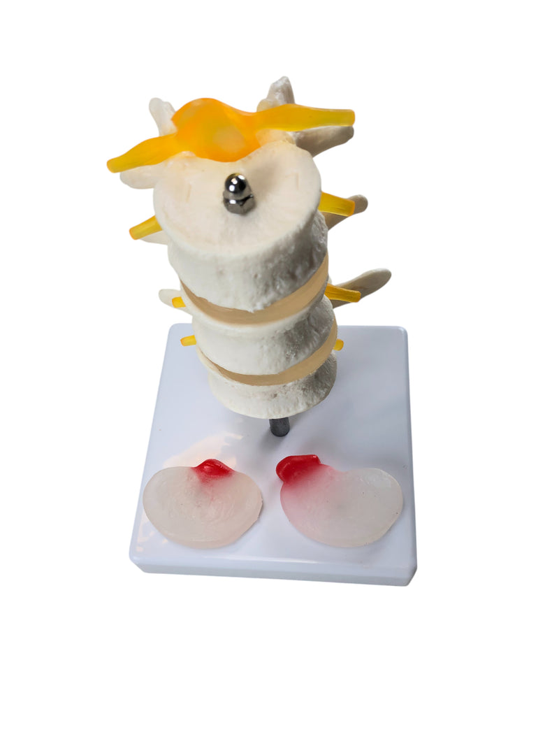 Load image into Gallery viewer, Three Lumbar Vertebrae with Herniation and Prolapse Model
