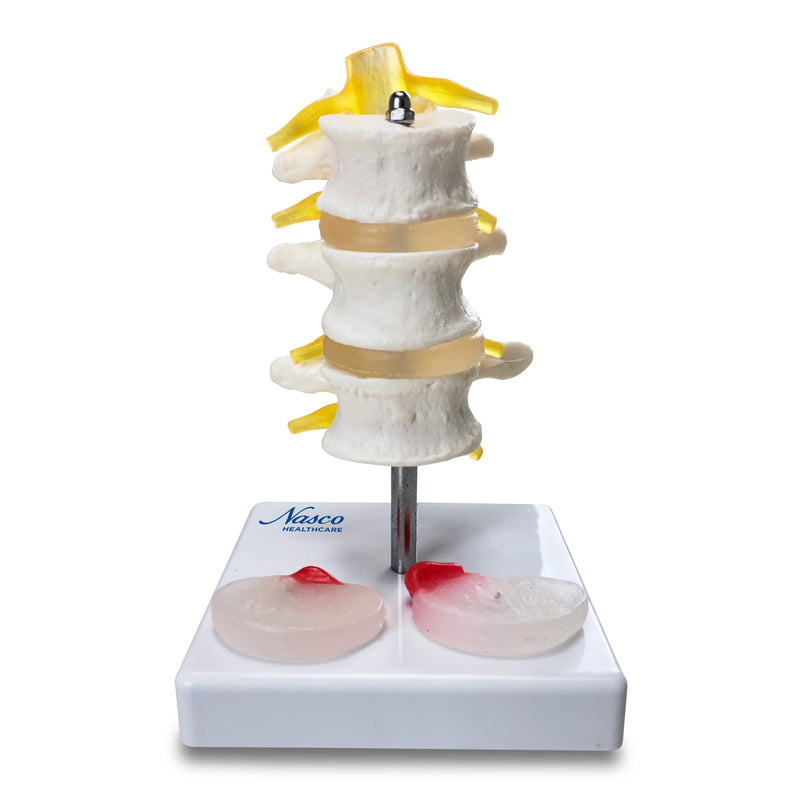 Load image into Gallery viewer, Three Lumbar Vertebrae with Herniation and Prolapse Model

