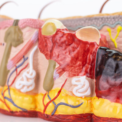 Skin Section with Burn Model, 30X Enlarged