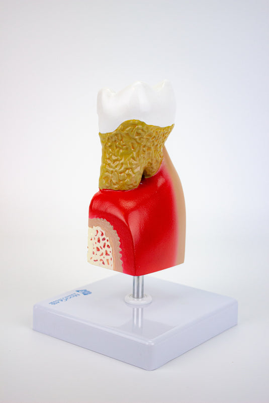 Modelo de Enfermedad Dental, 10X Ampliado [SKU: MG22727]