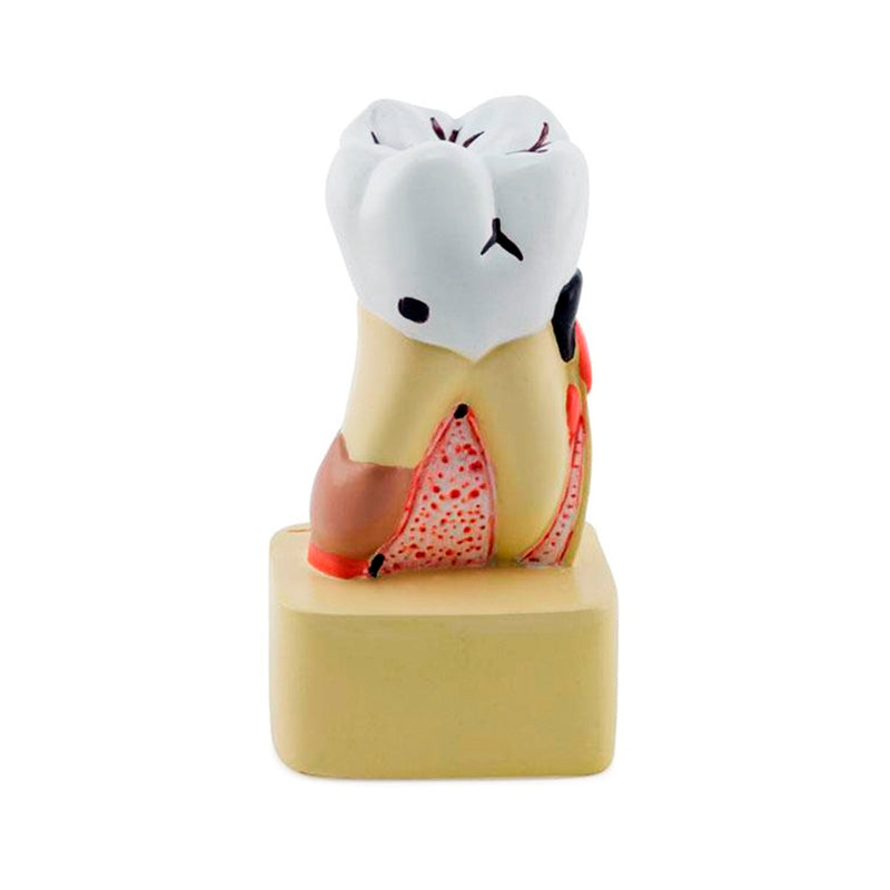 Cargue la imagen en el visor de la galería, Modelo de Enfermedad Dental, 4X Ampliado [SKU: MG22728]
