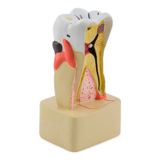 Modelo de Enfermedad Dental, 4X Ampliado [SKU: MG22728]