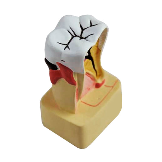 Modelo de Enfermedad Dental, 4X Ampliado [SKU: MG22728]